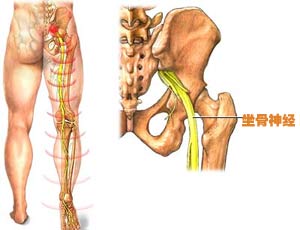 坐骨神经痛的症状（坐骨神经痛的症状在哪个部位图片）