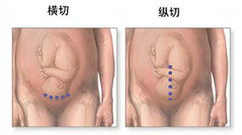 剖腹产横切还是竖切好 剖腹产横切还是竖切好?