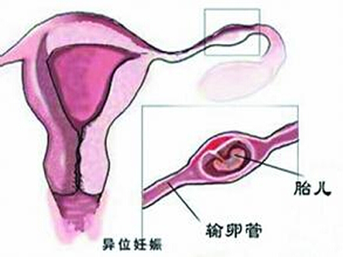 宫外孕是怎么引起的（宫角妊娠是什么原因引起的）