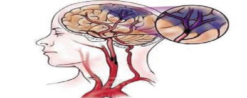 脑梗死是什么病 间歇性脑梗死是什么病