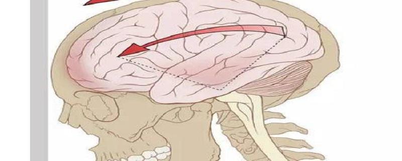 脑震荡的主要临床表现 脑震荡的主要临床表现不正确的是