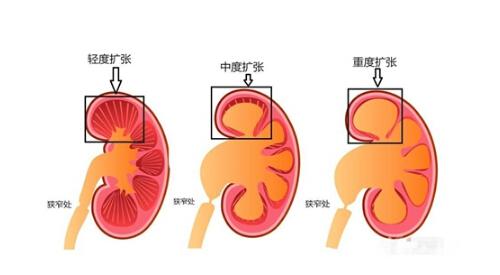 肾积水有哪些症状 肾积水有哪些症状 女性