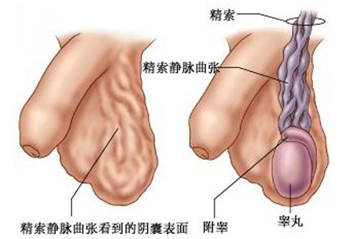 睾丸静脉曲张会疼吗 睾丸静脉曲张是血管疼还是睾丸疼