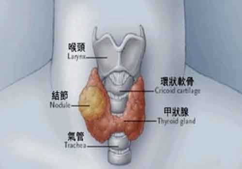 甲状腺结节能治愈吗 中医治甲状腺结节能治愈吗