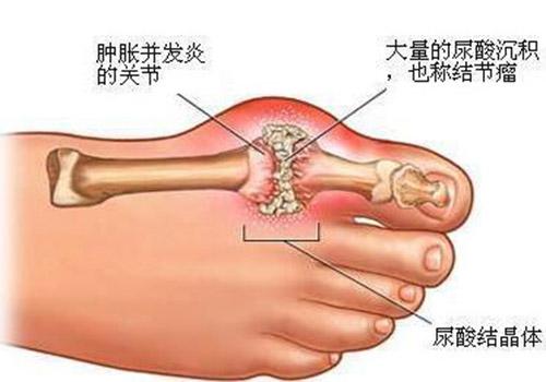 痛风用什么泡脚最好 有痛风的用什么泡脚更好