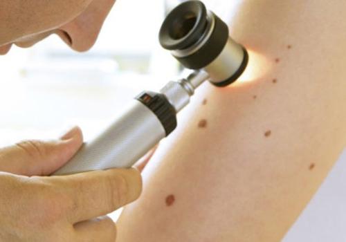 皮肤癌早期症状图片 皮肤癌早期症状图片 晚期