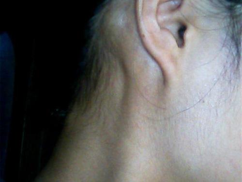 淋巴结肿大是怎么引起的（小儿淋巴结肿大是怎么引起的）