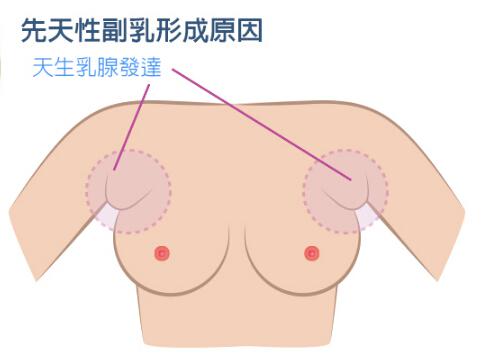 副乳的危害 真性副乳的危害