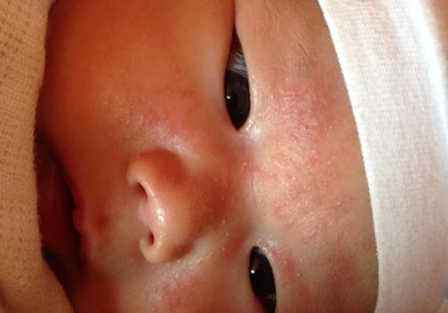 宝宝湿疹起皮是不是快好了 宝宝湿疹起皮是不是快好了的表现
