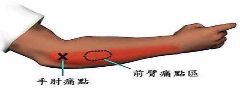 网球肘艾灸要哪个位置（网球肘的艾灸疗法）