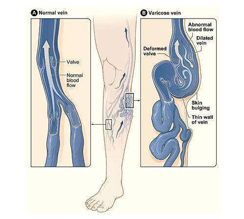 下肢静脉曲张有什么危害（下肢静脉曲张有哪些危害）