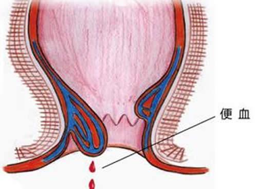 产后便血怎么回事 产后便便有血怎么回事