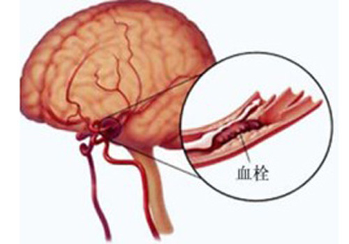 脑血栓能治好吗（轻微脑血栓能治好吗）