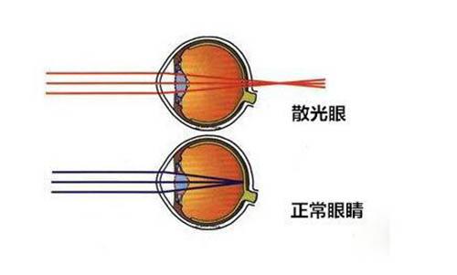 散光的原因 散光眼的治疗方法