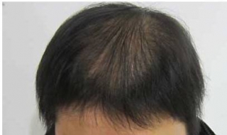 头发稀少方法 遗传头发稀少怎么办，提前预防