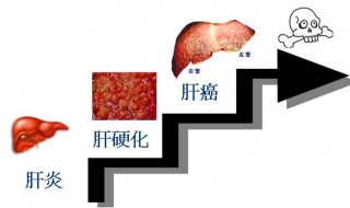 肝功能异常怎么办 肝功能异常抗可用病毒方面的药物