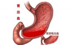 胃出血的原因 对症治疗很重要