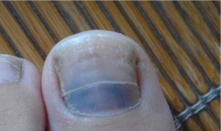 脚指甲变厚怎么办 可以涂抹相应的药膏