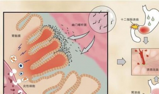 胃镜检查后注意事项 做完胃镜之后有一些需要注意的事项