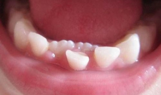 乳牙滞留怎么办 不同的处理方案推荐