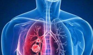 肺炎的症状 及其治疗方法