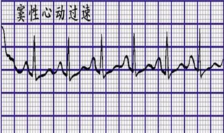 窦性心动过速怎么办 注意原发病的饮食宜忌