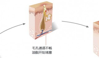 毛孔堵塞长痘怎么办 毛孔堵塞长痘解决方法