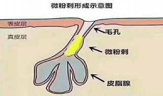 如何有效应对毛孔堵塞（改善毛孔堵塞的方法）