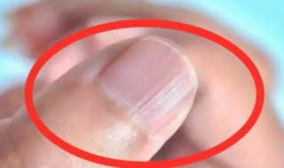指甲上为什么有竖纹 指甲上为什么有竖纹凹凸不平