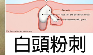 脸上长粉刺是什么原因怎样去掉 脸上长粉刺是什么原因怎样去掉图片