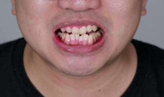 祛除牙渍小妙招 祛除牙渍小妙招图片