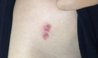 刚种的吻痕热敷还是冷敷 吻痕冷敷有用吗