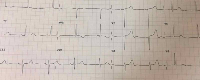 t波改变是什么意思？ 心电图t波改变是什么意思