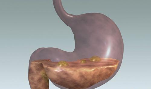 胃炎是怎么引起的 浅表性胃炎是怎么引起的