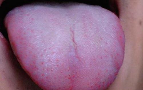 艾滋病初期舌头症状 艾滋病初期舌头症状是什么样的