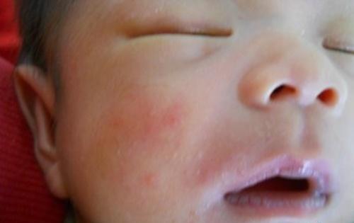 婴儿脸上起小红疙瘩（20天婴儿脸上起小红疙瘩）