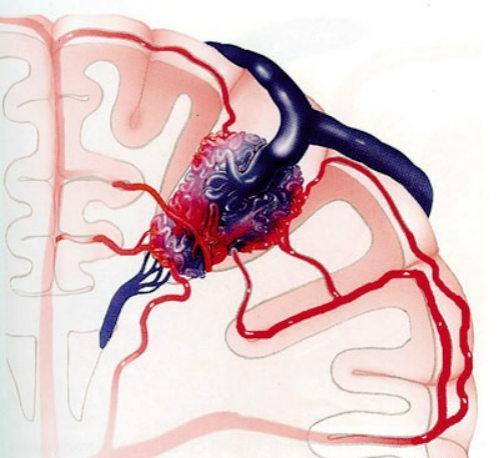 脑动静脉畸形（脑动静脉畸形介入手术后遗症）