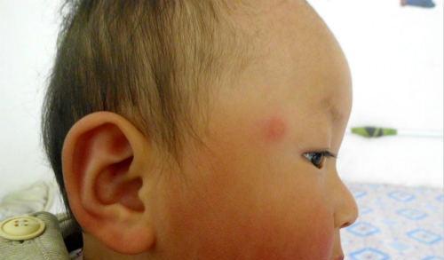 脸上起红疙瘩 脸上起红疙瘩不疼不痒怎么回事