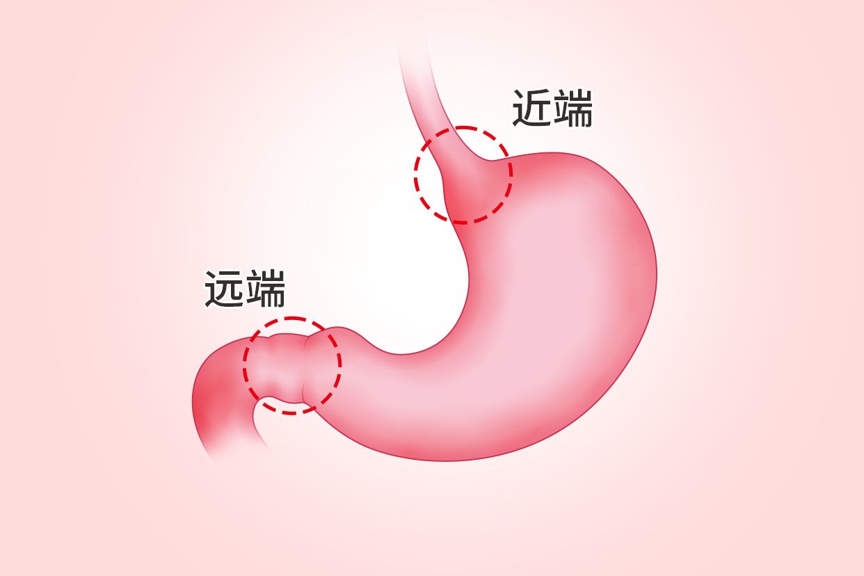 胃远端与近端的区别图（胃远端与近端的区别图片大全）