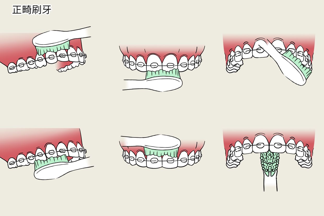 正畸刷牙步骤图片（正畸的刷牙方法）
