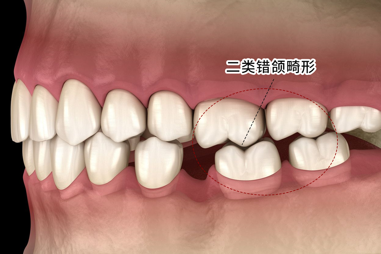 二类错颌畸形图片（错颌畸形二类二分类）