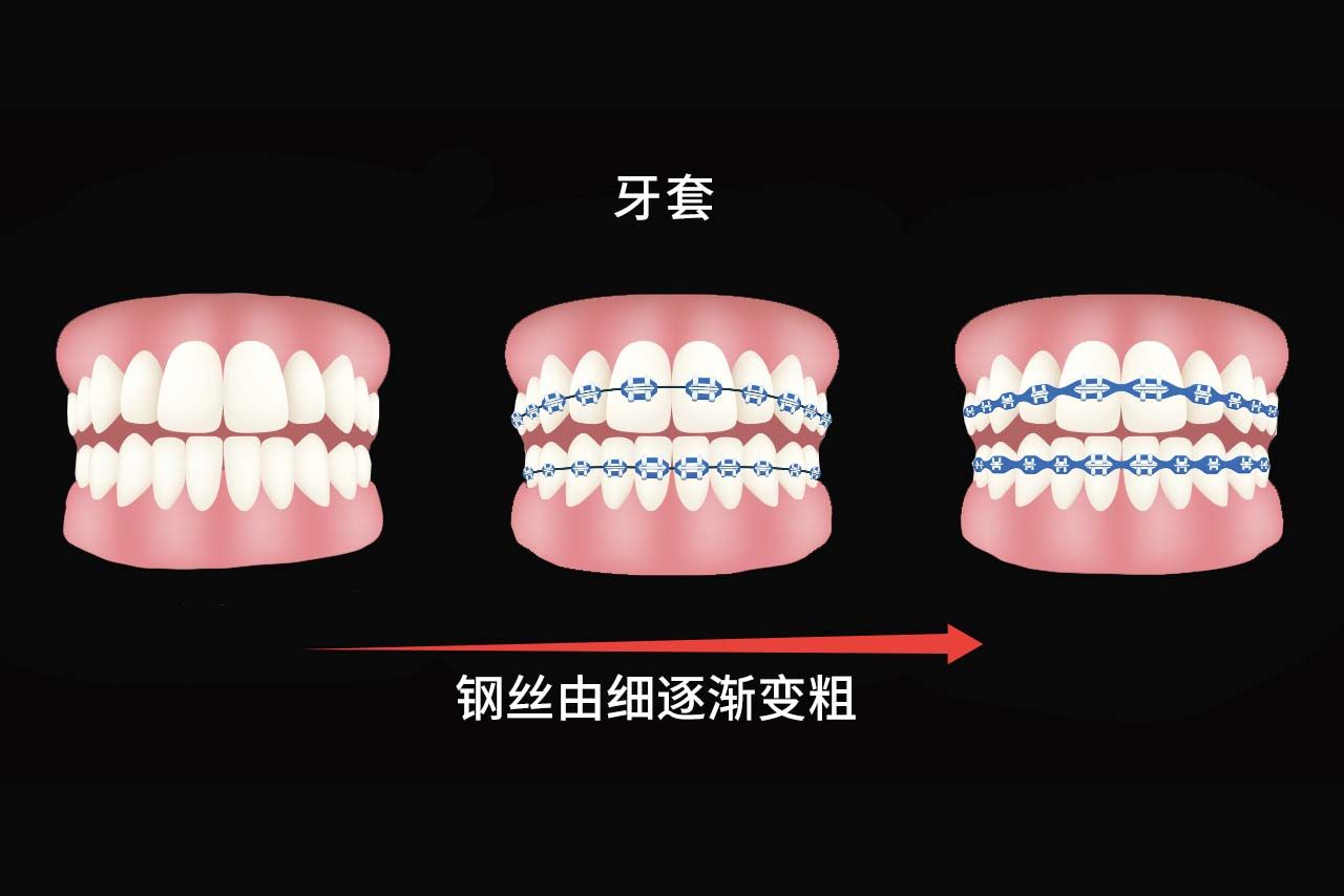 牙套换钢丝粗细顺序图片（牙齿矫正挂皮筋属于什么时期）