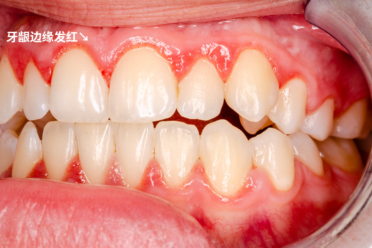 轻度牙龈炎症状图片 急性牙龈炎症状图片