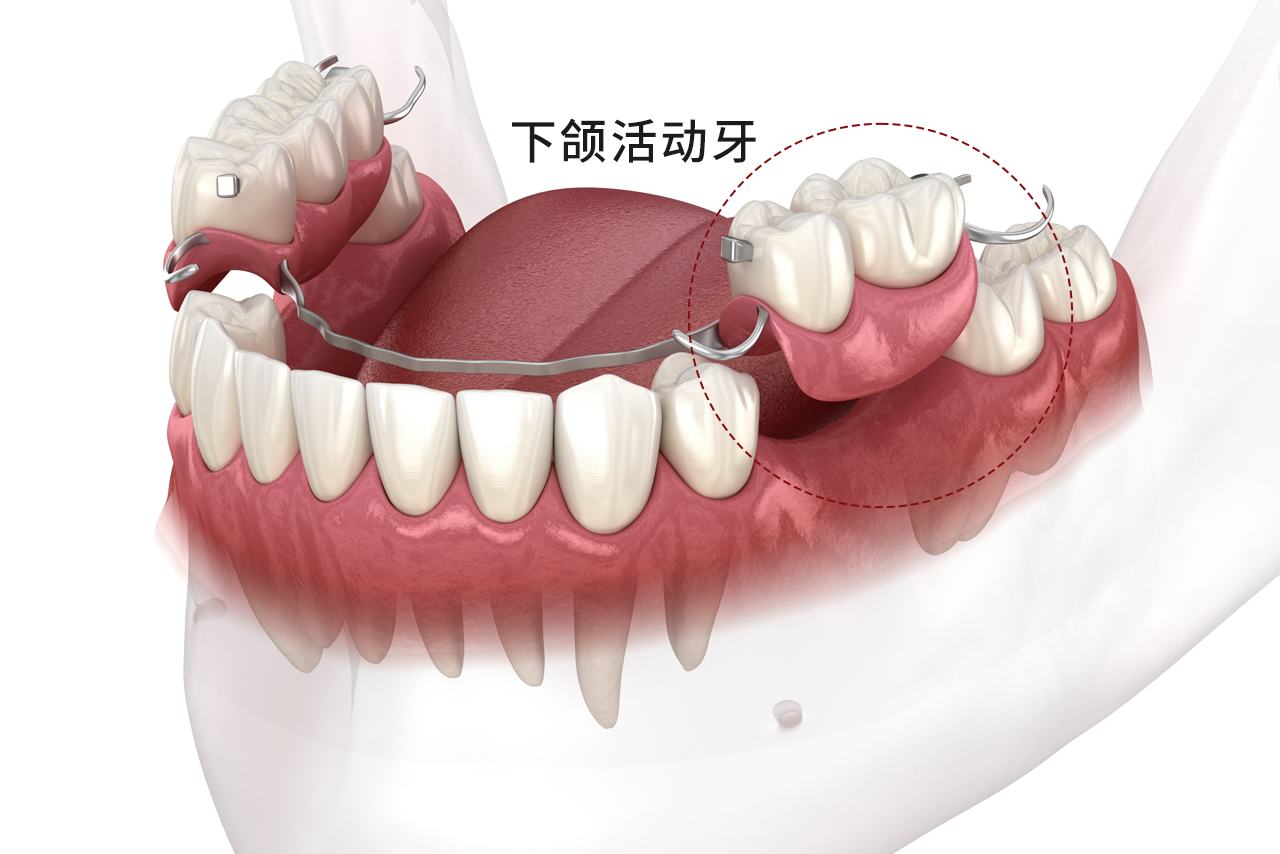 下颌活动牙图片 上颌活动牙图片
