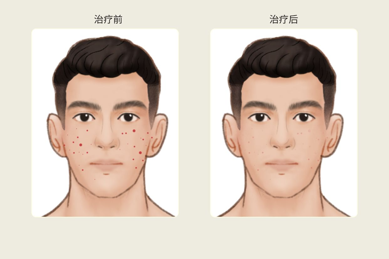 脉冲染料激光595掉痂后图（595脉冲激光后没有结痂）