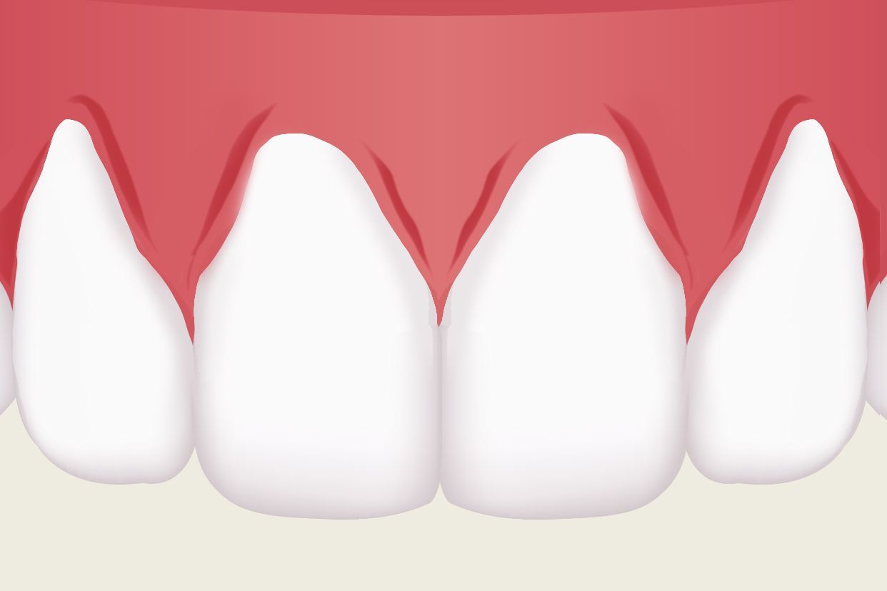 做一个牙龈修复效果图 做一个牙龈修复效果图多少钱