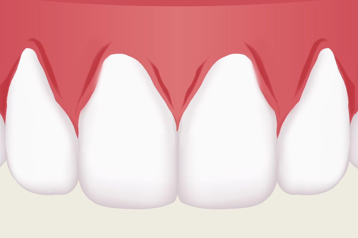 上排侧面牙牙龈萎缩图（下前牙牙龈萎缩图片）