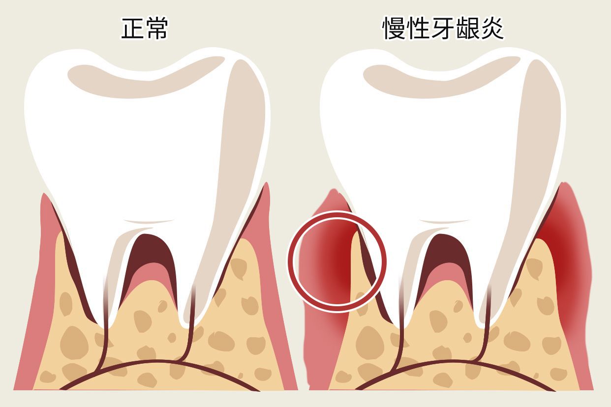 慢性牙龈炎图片 慢性边缘性牙龈炎图片
