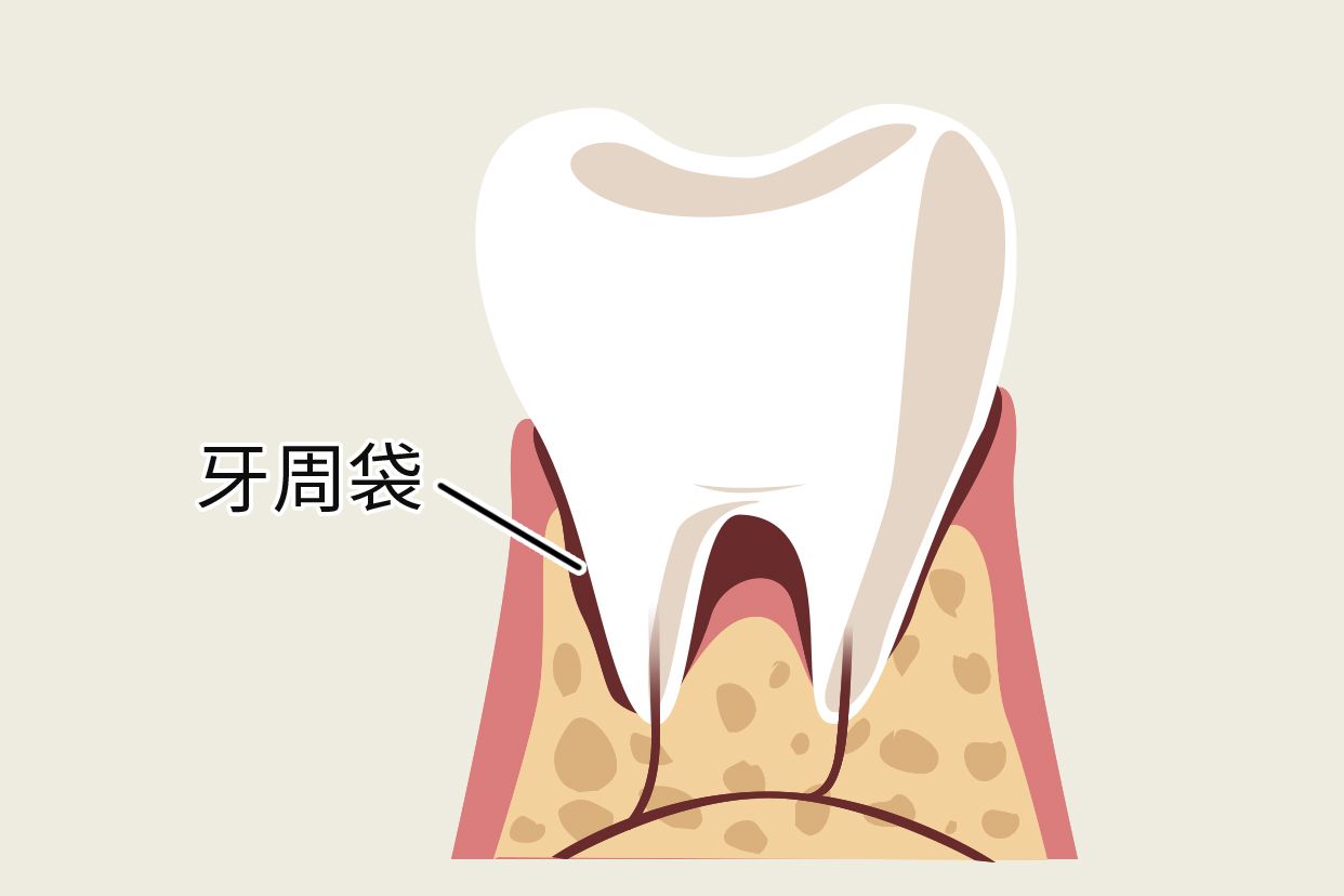 什么是牙周袋及图片