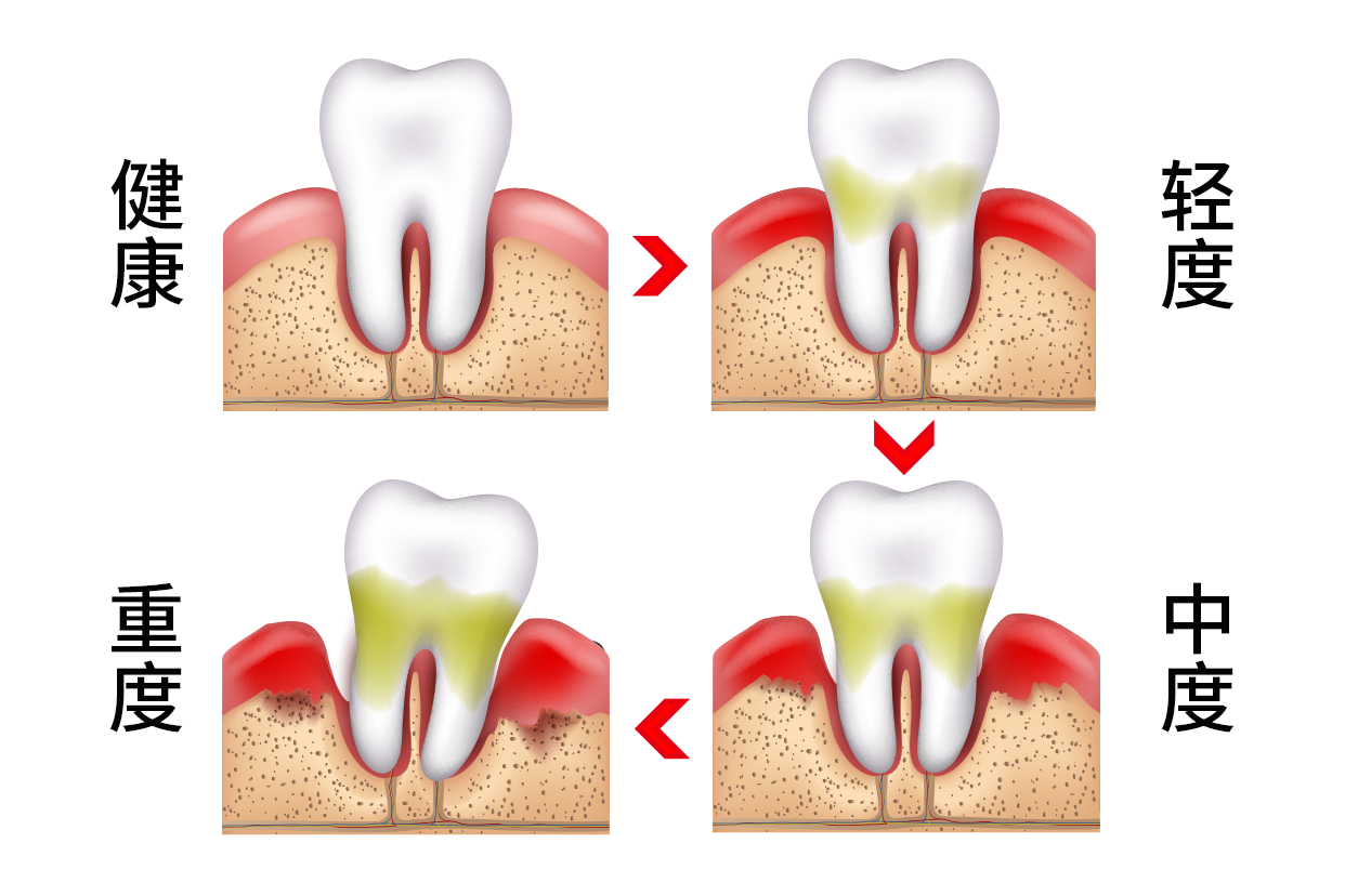 牙周轻中重度前后图片